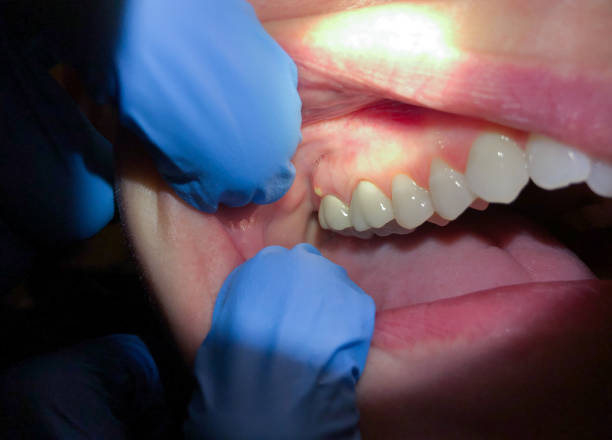 Best Emergency Dental Care for Broken or Chipped Teeth in USA